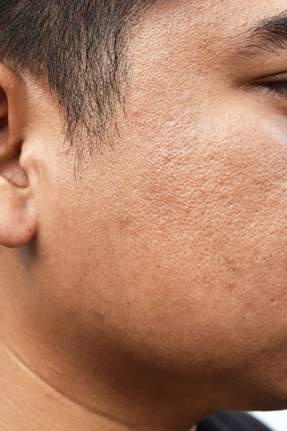 Soins du visage pour peau acnéique